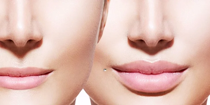 Zväčšenie pier s výplňou Princess® Filler alebo Teosyal Kiss PureSense