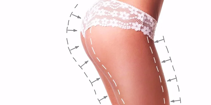 Laserová liposukcia s lymfodrenážou
