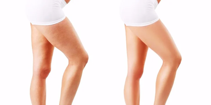 Postavička ako lusk s ultrazvukovou liposukciou, rádiofrekvenciou a lymfodrenážou
