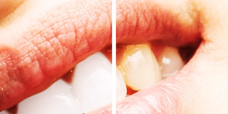 Dentálna hygiena a bielenie zubov lampou Zoom! Ako darček medzizubná kefka! Využitie až na 4 pobočkách v Bratislave a okolí