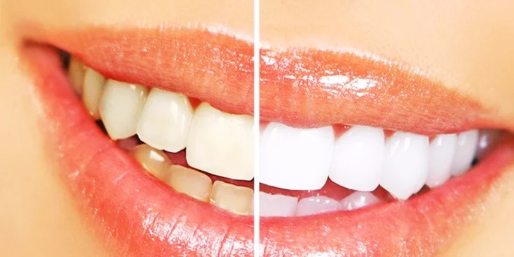 Dentálna hygiena, bielenie alebo plombovanie s viac ako polovičnou zľavou!