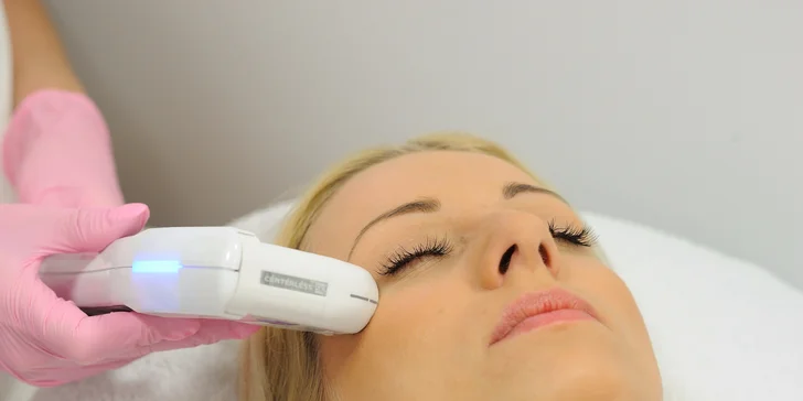 Nechirurgický facelifting čela a okolia očí s efektom nadvihnutia obočia. Omladnite Ultherapiou!