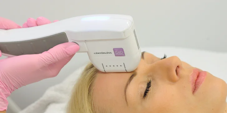 Nechirurgický facelifting čela a okolia očí s efektom nadvihnutia obočia. Omladnite Ultherapiou!