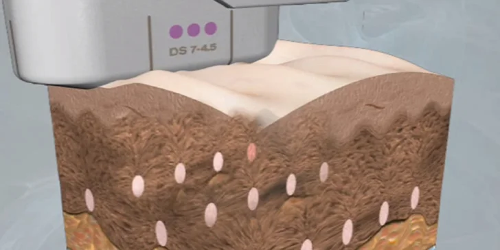 Nechirurgický facelifting čela a okolia očí s efektom nadvihnutia obočia. Omladnite Ultherapiou!
