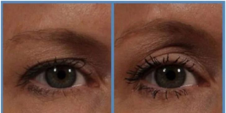 Nechirurgický facelifting čela a okolia očí s efektom nadvihnutia obočia. Omladnite Ultherapiou!