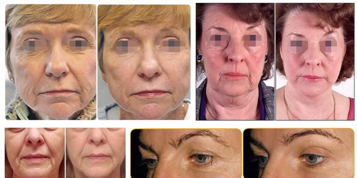 Hifu Ultherapy - Nechirurgický facelifting čela a očného okolia, lifting paží či krku a podbradku