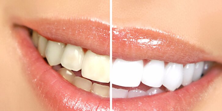 Dentálna hygiena s fluoridáciou, bielenie zubov alebo liečba zuba vŕtaním a biela plomba - prehliadka zdarma!