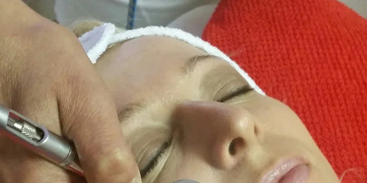 Výplň vrások kyselinou hyalurónovou, vitamínom C a rádiofrekvenciou