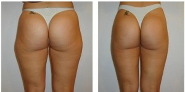 Medicínska laserová liposukcia