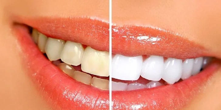 Dentálna hygiena, pieskovanie, bielenie + vstupná prehliadka