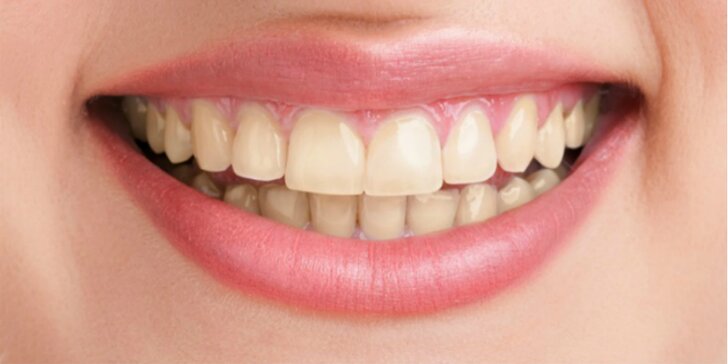Kozmetické bielenie zubov PEARLSMILE®. 3. ošetrenie ZDARMA!