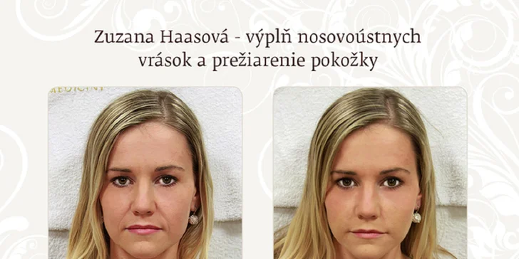 Prvýkrát na Zľavomate! Odstránenie nosovo-ústnych vrások v IEM