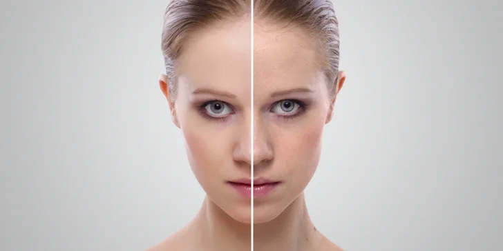 3D fotorejuvenizácia - krásna a omladená pleť s neinvazívnym liftingom