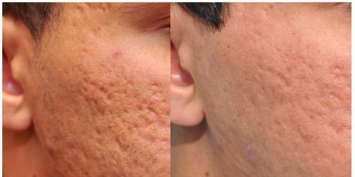 Cooltouch Laser - unikátna laserová rejuvenizácia pleti, liečba akné a odstránenie jaziev po akné