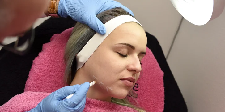 Omladenie a vyhladenie jemných vrások s mezoterapiou tváre alebo krku a dekoltu. NOVINKA: mezoterapia očného okolia alebo vlasov