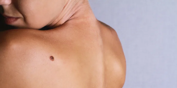 Vyšetrenie znamienok digitálnym dermatoskopom