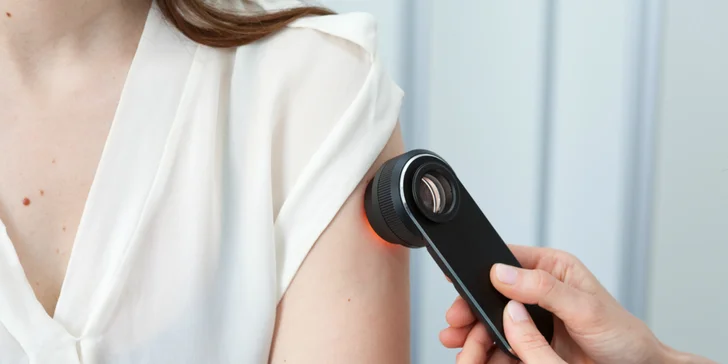 Vyšetrenie znamienok digitálnym dermatoskopom