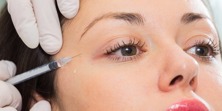 Mezoterapia tváre, očného okolia, krku, dekoltu alebo vlasov