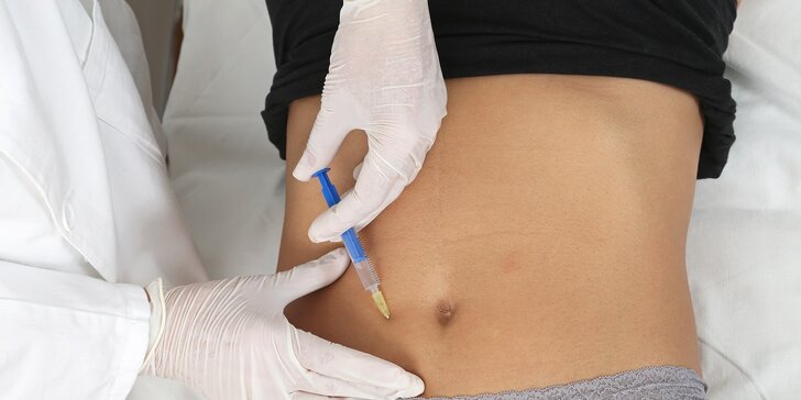 Odstránenie strií pomocou injekčného napnutia pokožky
