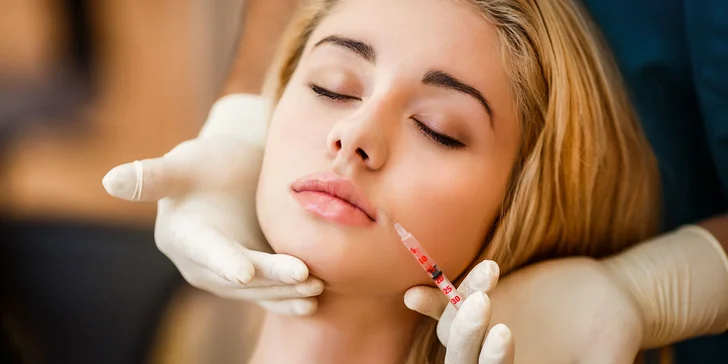 Aplikácia kyseliny hyalurónovej Princess ® VOLUME pre korekciu hlbokých vrások
