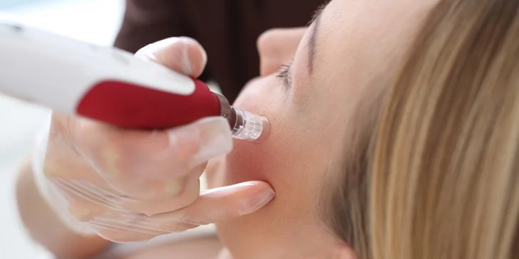 Doprajte svojej pleti výrazné omladenie pomocou microneedlingu