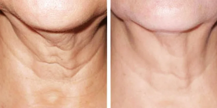 LETNÁ Mezoterapia s „botoxovým účinkom“ pre lifting a hydratáciu kože
