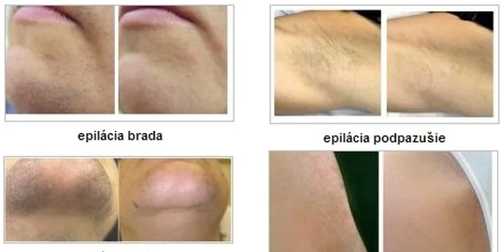 Epilácia chĺpkov najmodernejším IPL prístrojom