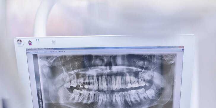 Dentálna hygiena s odstraňovaním zubného kameňa