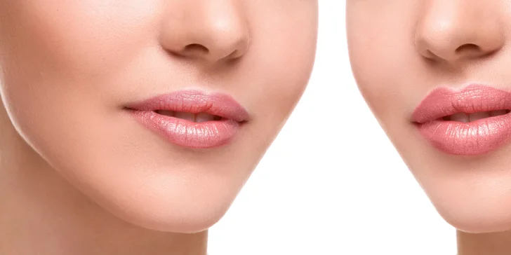 Zväčšenie pier výplňou Princess® Filler alebo Princess® Volume