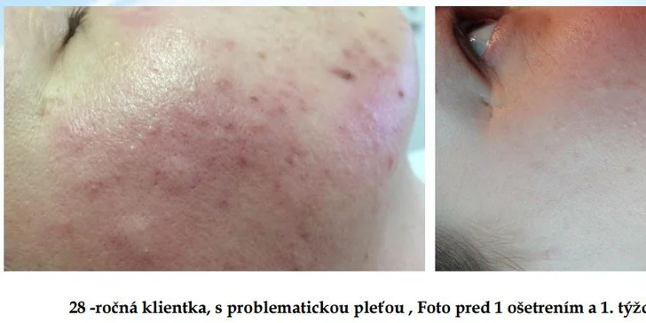 HYDRAFACIAL - kompletné ošetrenie tváre vrátane aplikácie peptidov