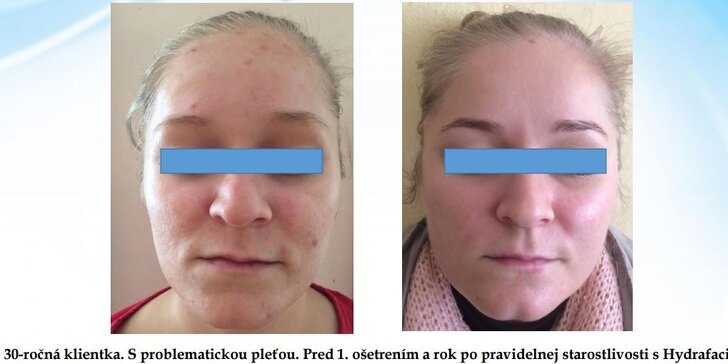 HYDRAFACIAL - kompletné ošetrenie tváre vrátane aplikácie peptidov