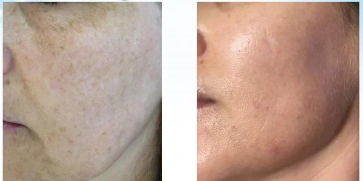 HYDRAFACIAL - kompletné ošetrenie tváre vrátane aplikácie peptidov