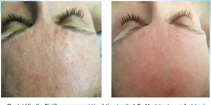 HYDRAFACIAL - kompletné ošetrenie tváre vrátane aplikácie peptidov