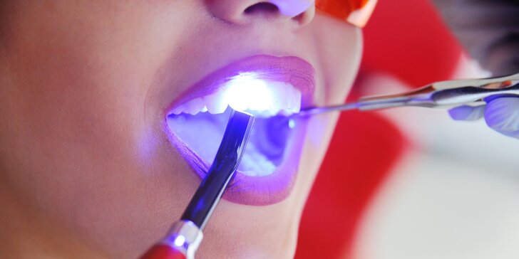 Bielenie zubov systémom ZOOM 2 alebo otvorený voucher v CENT DENT