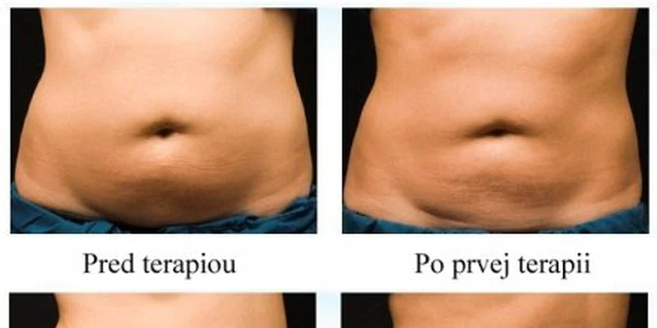 57 eur za odstránenie tuku turbokryolipolýzou. Neinvazívne, bezbolestné a trvalé odstráneniu tuku pomocou chladu a cvičenia na vibračnej plošine Power Plate. So zľavou 85%!