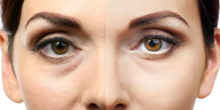IPL laserové omladenie a S-LIGHT FOTOTERAPIA