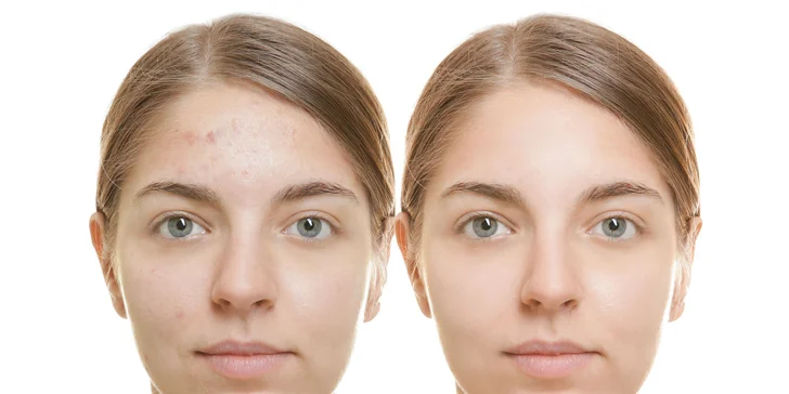 IPL laserové omladenie a S-LIGHT FOTOTERAPIA