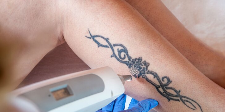Odstránenie tetovania pomocou laseru