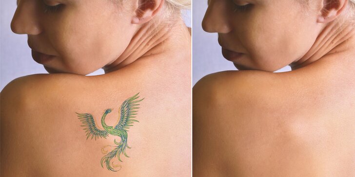 Odstránenie tetovania pomocou laseru