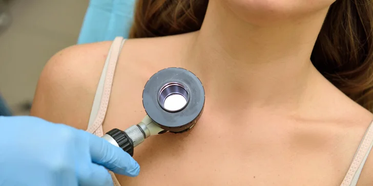 Dermatoskopické vyšetrenie znamienok v Chirkoze