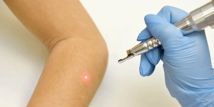 Dermatoskopické vyšetrenie znamienok v Chirkoze