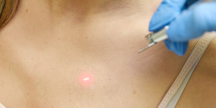 Dermatoskopické vyšetrenie znamienok v Chirkoze