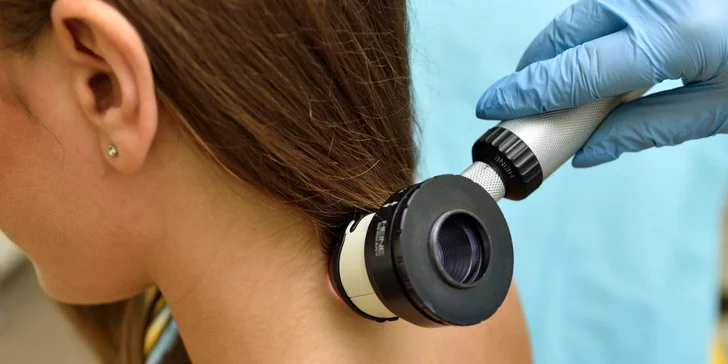 Dermatoskopické vyšetrenie znamienok v Chirkoze