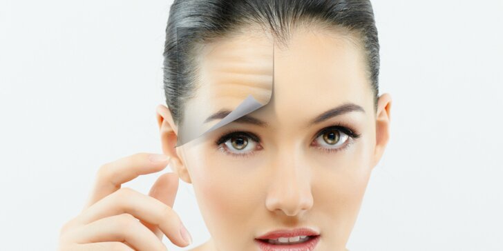 Vyplnenie vrások Botoxom - okolie očí, čelo alebo medziobočie