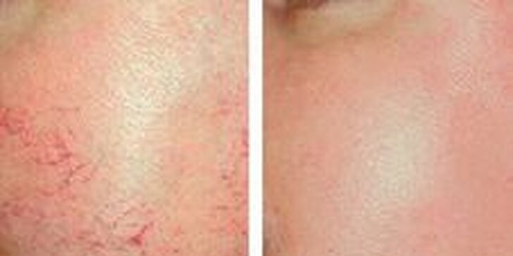 Okamžité odstránenie červených žiliek na tvári a tele