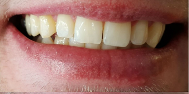 Revolučné expresné bielenie zubov bez peroxidu