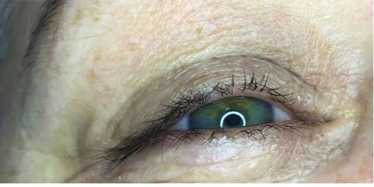 Rádiofrekvencia očného okolia či LASH LIFTING