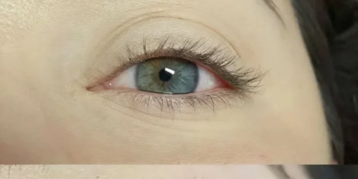 Rádiofrekvencia očného okolia či LASH LIFTING