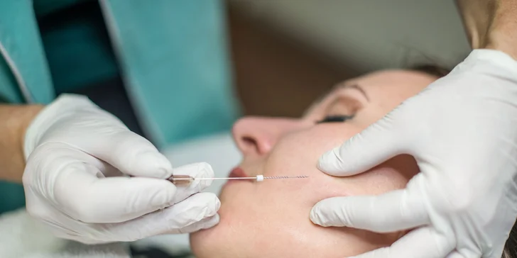 Špeciálny lifting tváre vykonávaný pomocou vstrebateľných nití