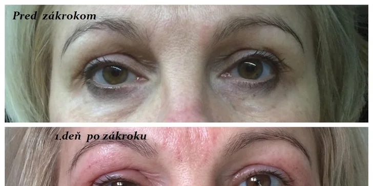 Korekcia viečok bez chirurgického zákroku